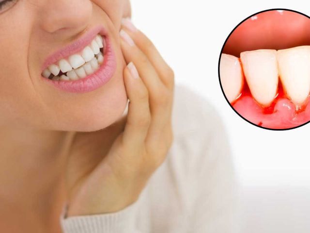 Types of Gum Disease