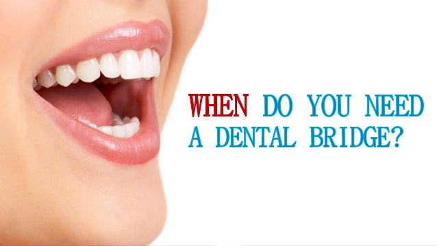 When do you need a Dental Bridge?