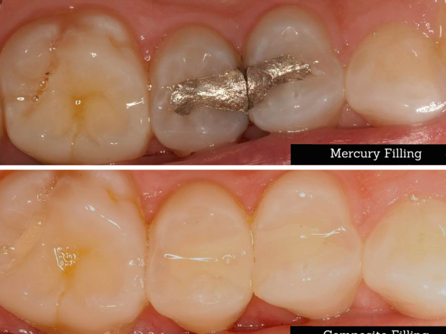 What are Composite Fillings (AKA White Fillings)?