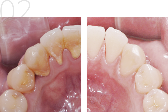 Dental Hygiene: Scaling and Root Planing