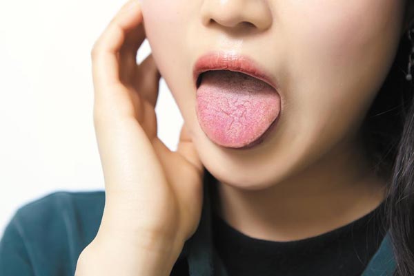 How does Dry Mouth Affect Oral Health?