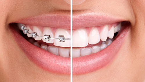 Orthodontic Treatment: how does it work?