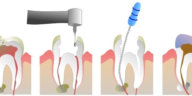 How does Root Canal work?